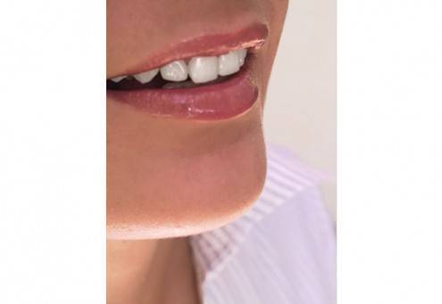teeth-whitening